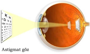 Astigmat Göz Belirtileri ve Tedavisi