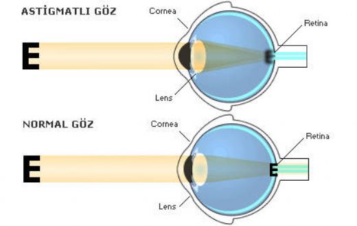 Miyop Astigmat Lens